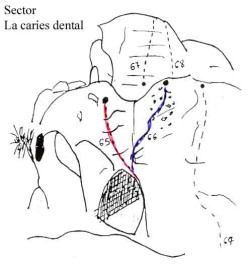 Croquis La Caries Dental 